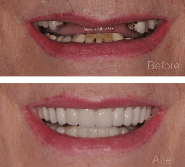 Implant Dentures in Vancouver, WA
